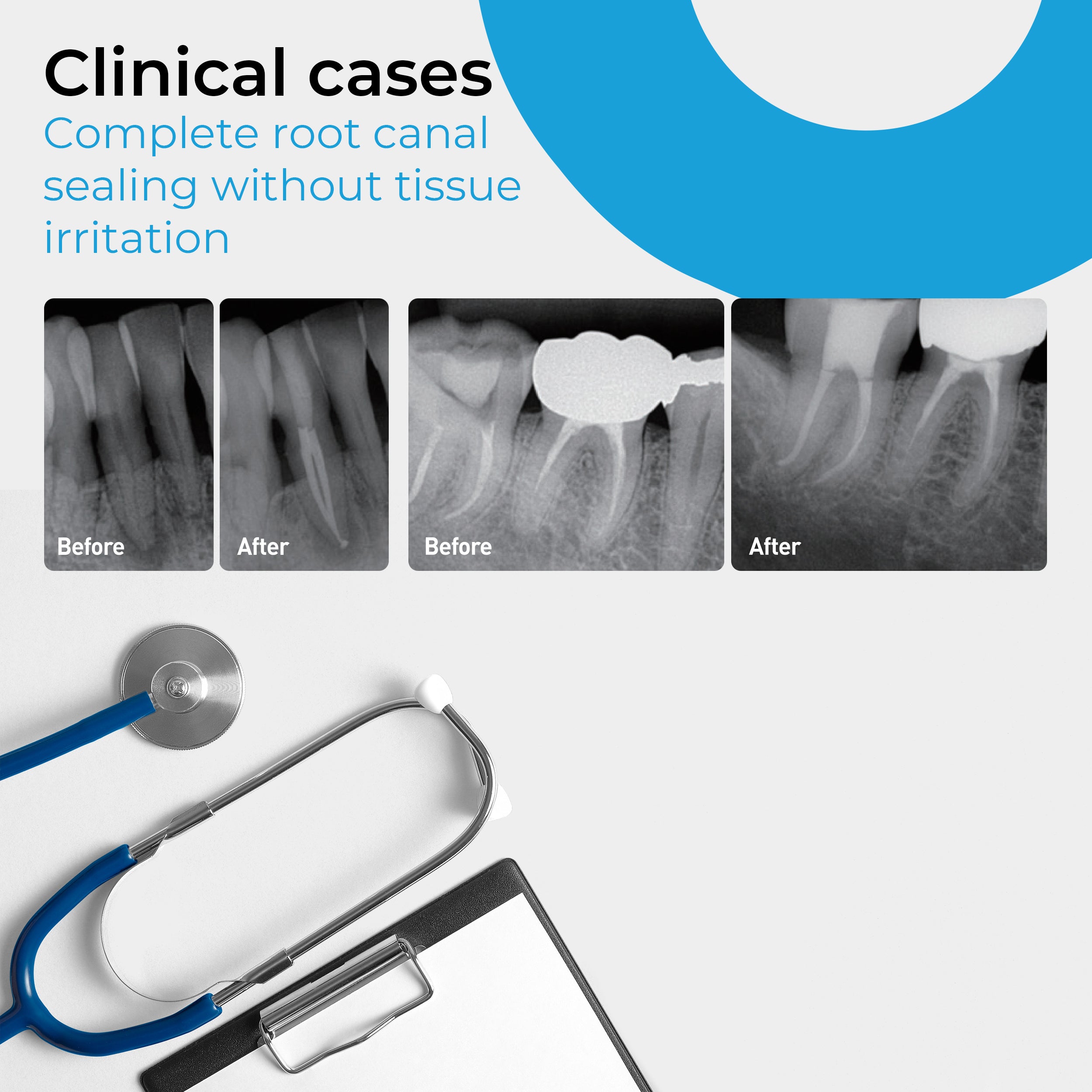 Bio Sealer for Root Canal