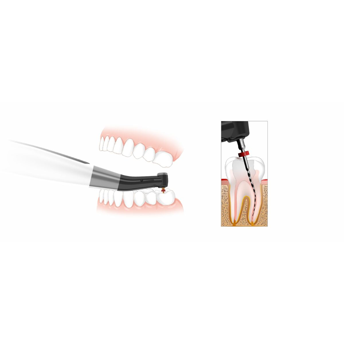 Endomatic Endo Motor Head by DTE Woodpecker (8862328389887)