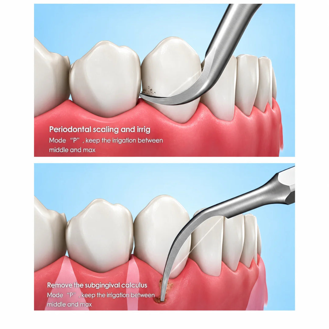 DTE PD1 Periodontal Ultrasonic Scaler Tip