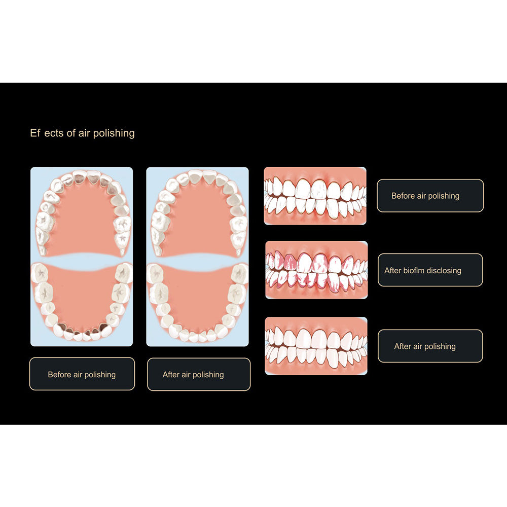 Woodpecker Dental Air Polisher AP-H Plus | Qudent